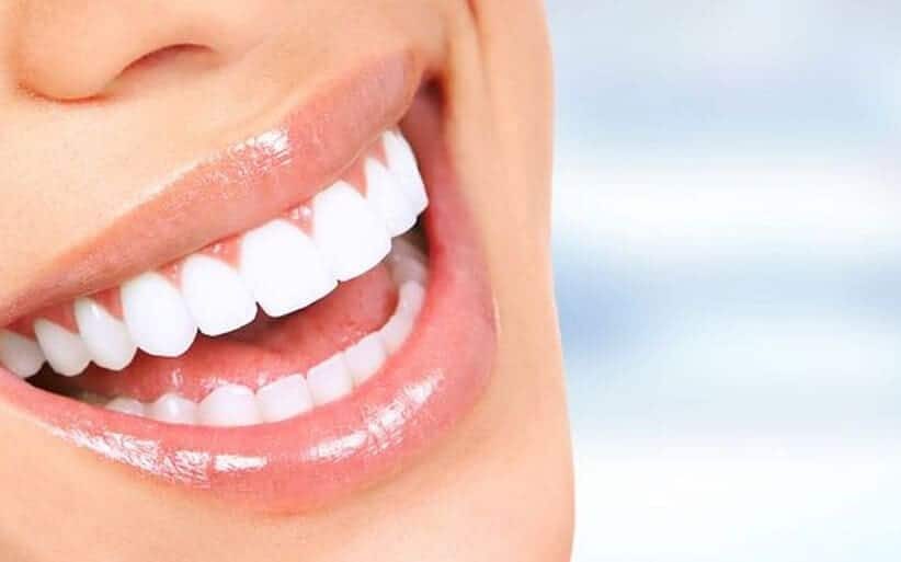 Sonrisa con carillas de zirconia: dientes blancos, naturales y alineados