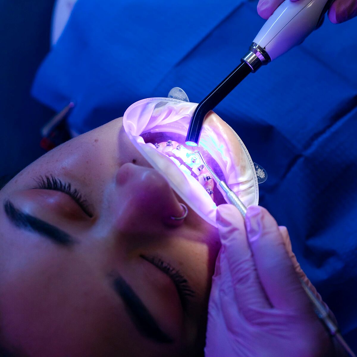 Blanqueamiento Dental