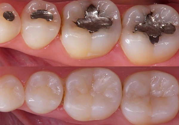 Cambio de la amalgama por la resina en un diente