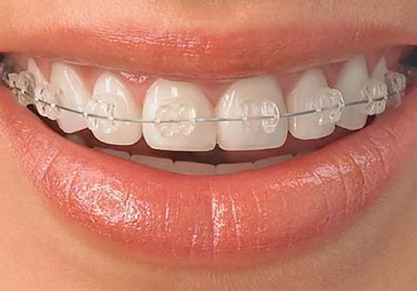 Ortodoncia o brackets transparentes y metal
