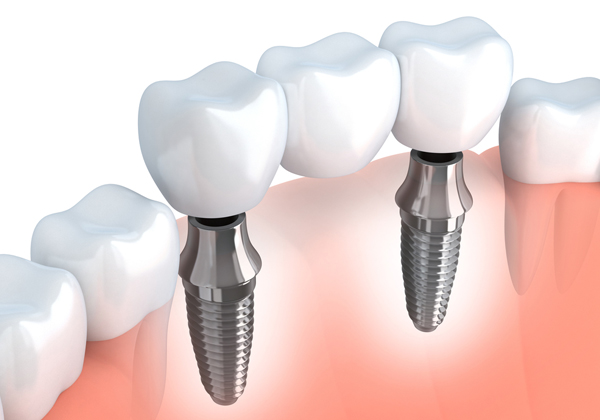 Implantes dentales de un o varios dientes