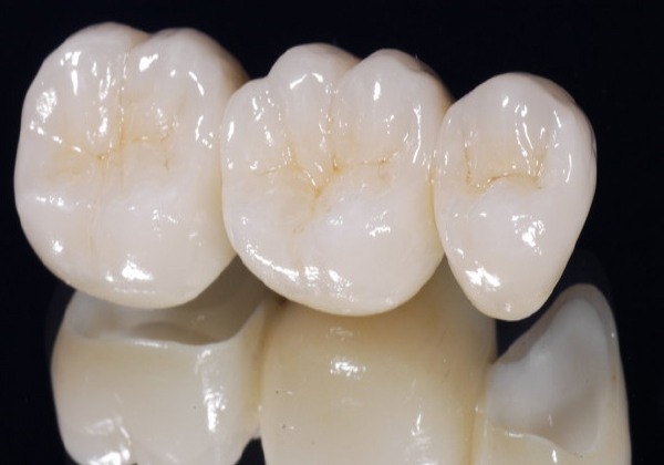 Protesis fija de varios dientes